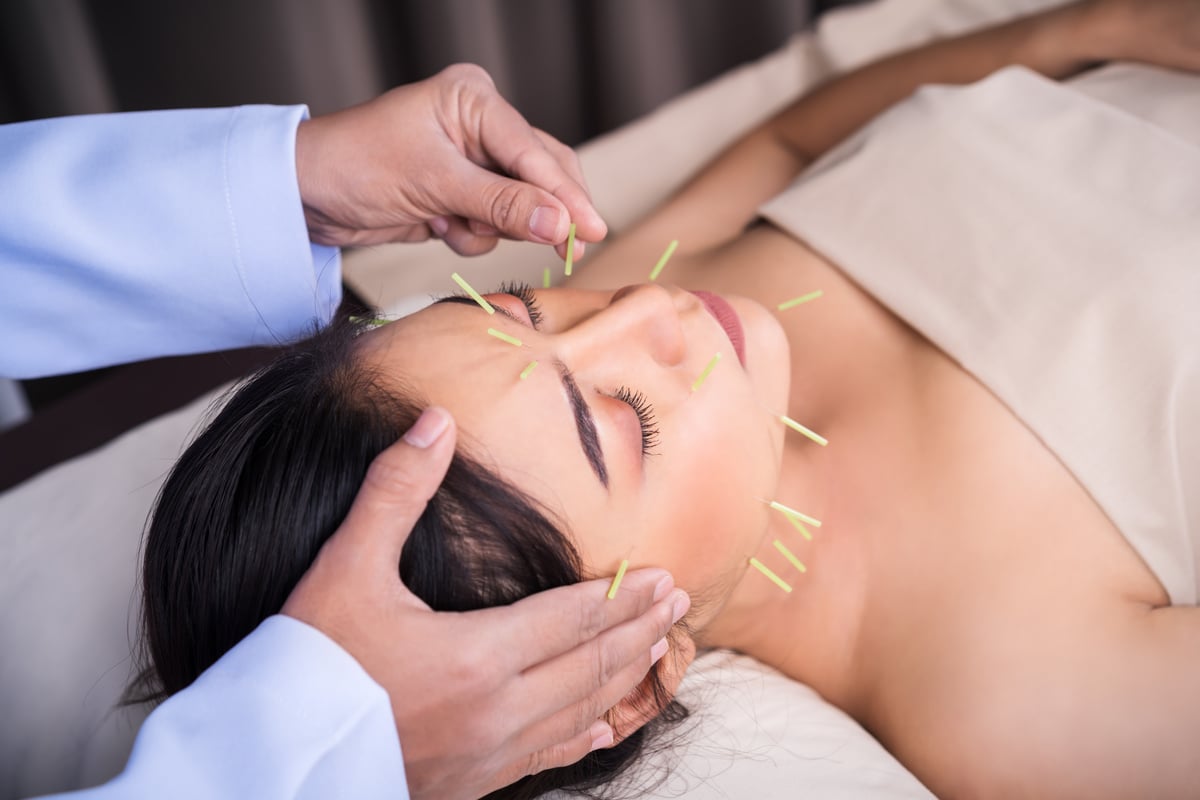 woman undergoing acupuncture treatment on face