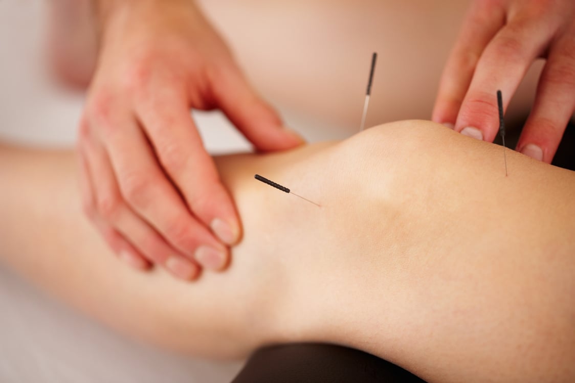 Acupuncture treatment